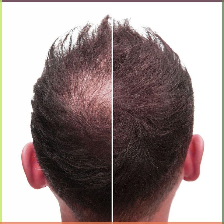 testosterone and hair growth connection