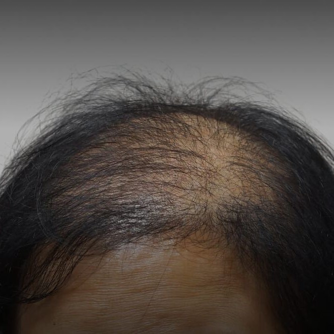 testosterone therapy hair effects